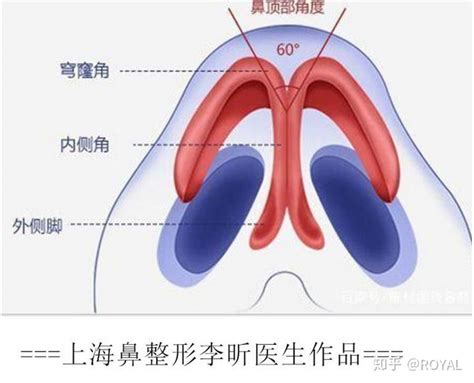 隆鼻医生李昕：我的大鼻头案例 知乎