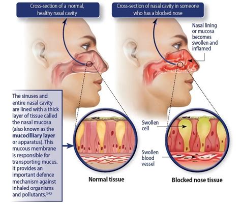 Blocked Nose - MedInformer