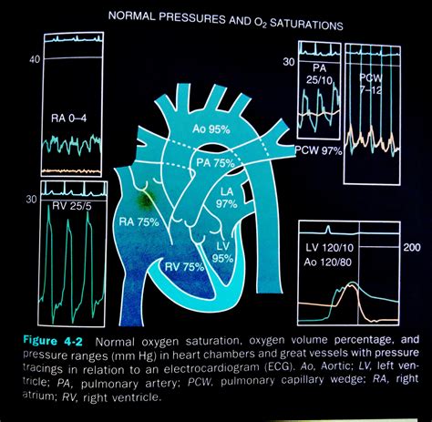 Hemodynamic waveforms resources : r/CathLabLounge