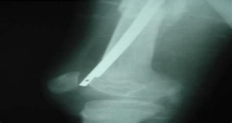 Pre Op And Immediate Post Op X Ray Of The Fracture Shaft Femur Managed