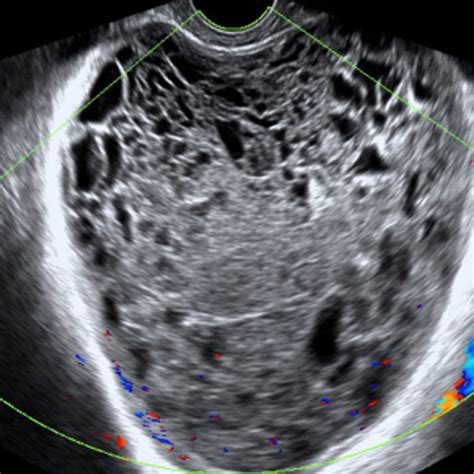 Dermoid Ovarian Cyst Ultrasound