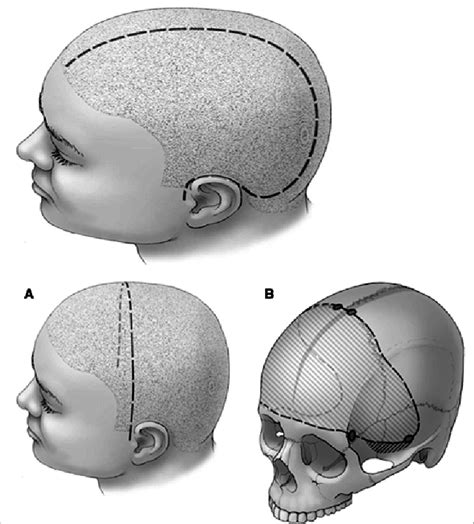 Skin Incisions And Extended Unilateral And Bifrontal Craniectomies