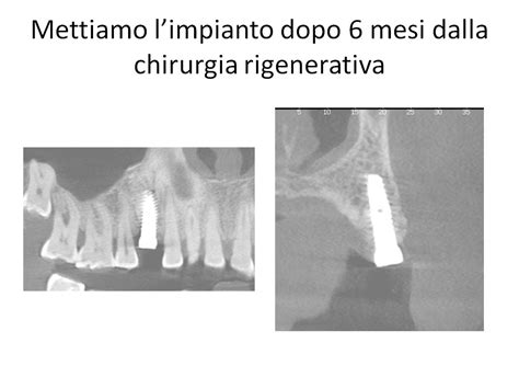 Rigenerazione Ossea Ed Impianto Dentista Roma