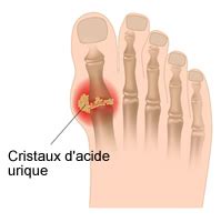 Probl Mes Courants Qui Touchent Le Pied Creapharma