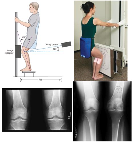 Rad Procedures Weight Bearing Lower Limb Flashcards Quizlet