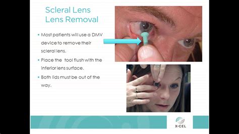 A Great Tool For Patients Who Wear Atlantis Scleral Contact Lenses