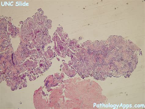 Histology Of Osteosarcoma