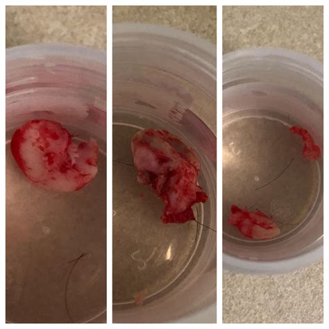 Last three cysts from my dome got scooped out today! : r/popping