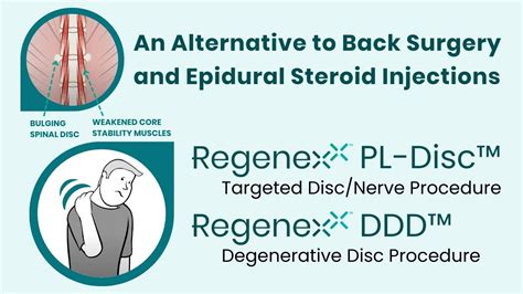 Regenexx Procedures For Spine Conditions Regenexx Las Vegas