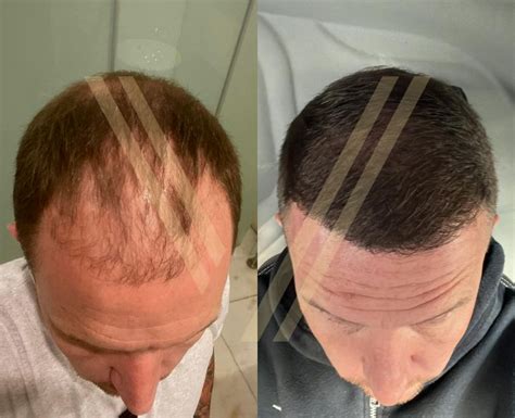 Hair Transplant Before And After Grafts