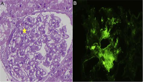 A Minimal Change Disease Compatible With C1q Nephropathy In A