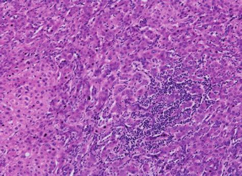 Hepatocellular adenoma-inflammatory subtype, HE ×200. | Download Scientific Diagram