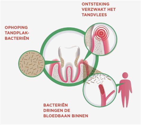 Het Verzorgen Van Uw Mondgezondheid Is Belangrijker Dan U Denkt