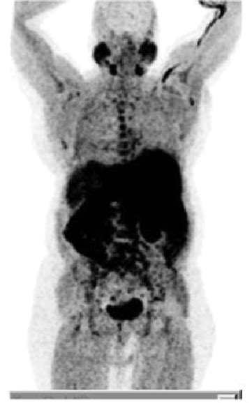 Maximum Intensity Projection Mip Positron Emission Tomography Pet