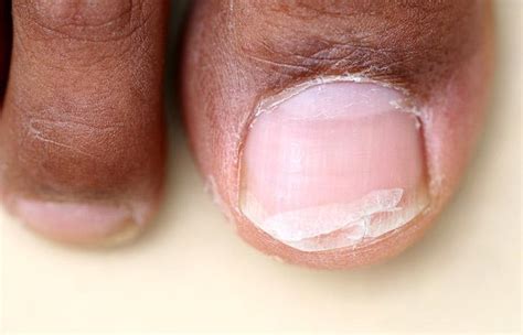 Vitamin Deficiency Fingernails Chart