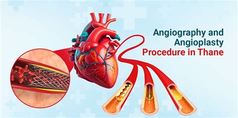 Comprehensive Angiography And Angioplasty Procedure In Thane