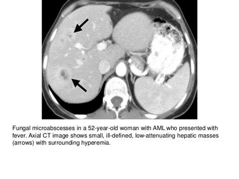 Hematologic Malignancies Of The Liver