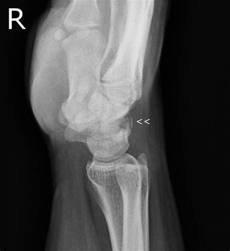 File Triquetral Fracture Radiopaedia 50260 55614 Lateral View Of Wrist Cropped Magnified