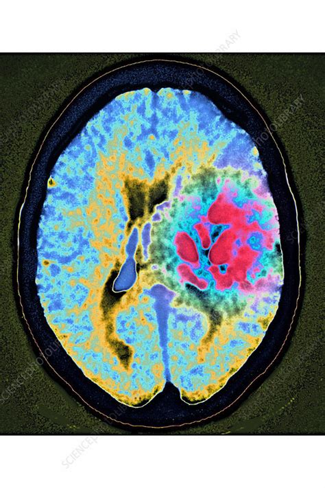 Angioma, MRI - Stock Image - C046/0181 - Science Photo Library