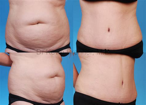 Does Insurance Cover Tummy Tuck After Bariatric Surgery Maynard Caraballo