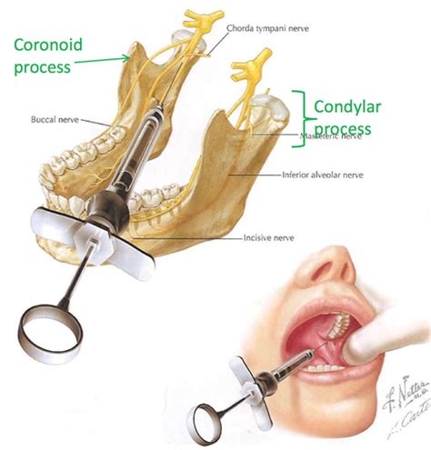 Anesthesia Mandibular Maxillary Injections Midterm Flashcards Quizlet