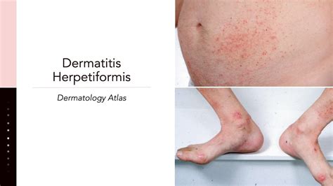 PDF] Dermatitis Herpetiformis: Celiac Disease Of The Report, 57% OFF