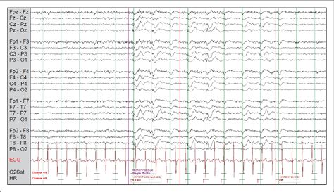 Figure From Role Of Electroencephalogram Eeg And Magnetic Resonance