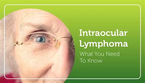 Intraocular Lymphoma What You Need To Know Mylymphomateam