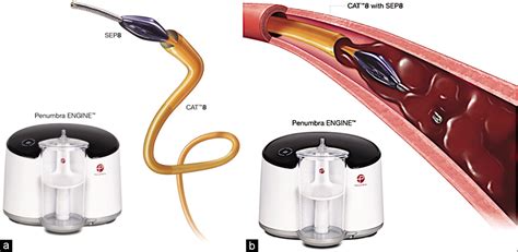 Current Endovascular Treatment Options in Acute Pulmonary Embolism ...