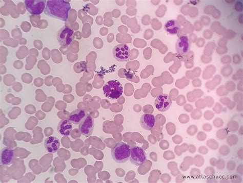 Leucemia mieloide crónica LMC LaboATLAS