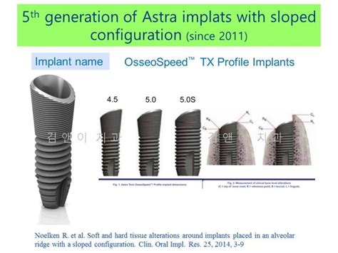 The Birth And Evolution Of Astra Implants아스트라 임플란트의 탄생과 진화 네이버 블로그