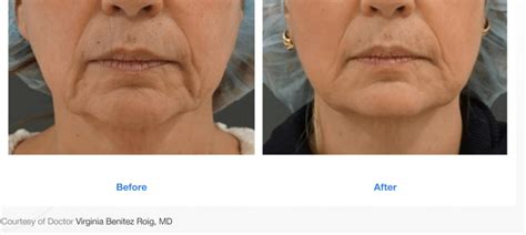 Sofwave Non Surgical Skin Tightening San Diego Ca Clderm