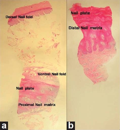 Proximal nail fold-lunula double punch technique: A less invasive ...