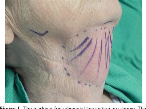 Figure 1 From Liposuction For The Management Of Submental Lymphedema In