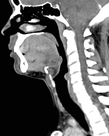 Thyroglossal Duct Cyst Radiology Case Radiopaedia Org