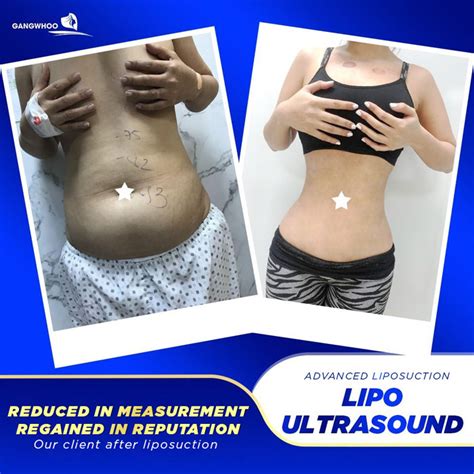 Lipo Ultrasound A Non Surgical And Safe Fat Reduction Procedure Gangwhoo Cosmetic Hospital