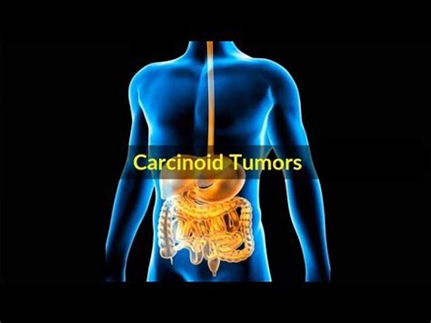 Carcinoid tumors Symptoms –Causes symptoms and pictures of Carcinoid tumor cancer in Men women ...