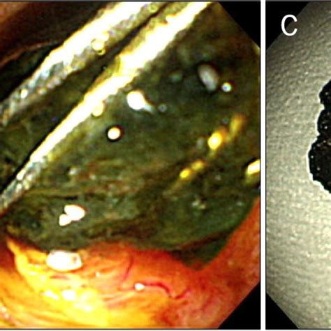 A Ercp Shows An Elongated Filling Defect Black Arrow In The Lower