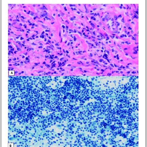 Poorly differentiated carcinoma. A, Histology shows nests of tumor ...