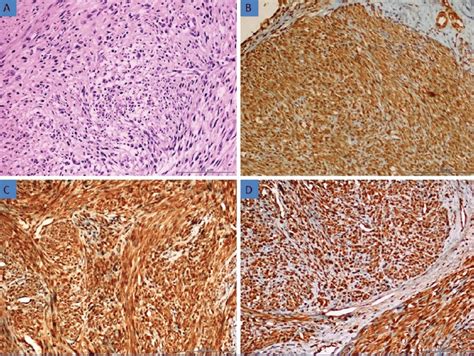 A Histomorphological Appearance Of The Smooth Muscle Tumour Of