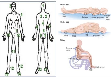 Pressure Injuries And Ulcers Flashcards Quizlet