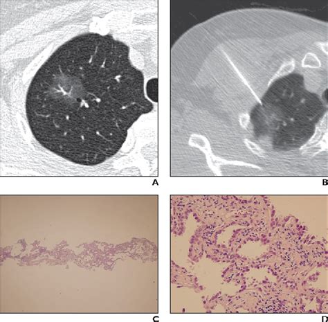 Figure 1 From Diagnostic Accuracy Of Ct Guided Core Biopsy Of Ground