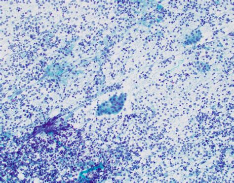 Bethesda System For Reporting Thyroid Cytopathology An Updated Review