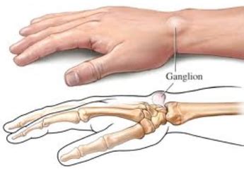 Ganglion Cyst - Hand & Elbow Conditions