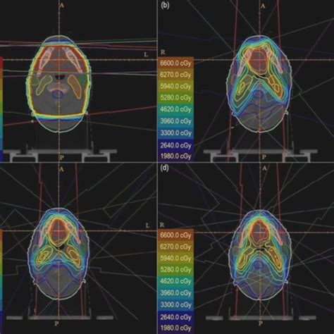 Differences In Dose Distribution For A 3d Crt B Imrt 5f C