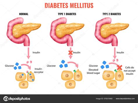 Anatomía Realista Del Páncreas Insulina Diabetes Mellitus Infografías