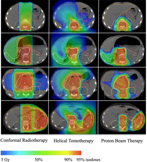 Dose Distribution In Four Illustrative Cases A Medulloblastoma B