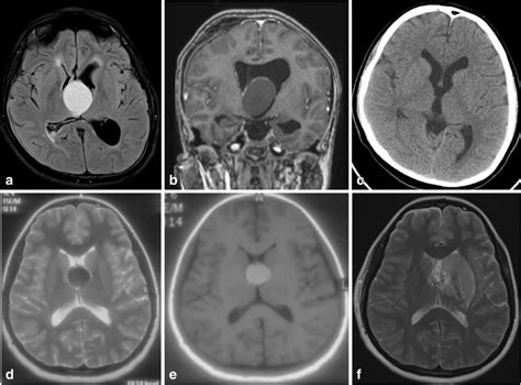 A Magnetic Resonance Imaging T2 Weighted Flair Image With A Download Scientific Diagram