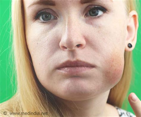 Facial Swelling Allergy Telegraph