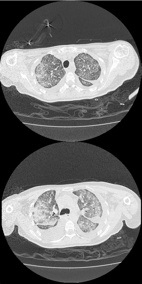 Figure 1 From Lung Cancer In Patients Diagnosed With Silicosis Should